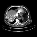 Acute heart failure (CT) (Radiopaedia 79835-93075 Axial C+ arterial phase 54).jpg