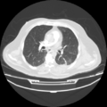 Acute heart failure (CT) (Radiopaedia 79835-93075 Axial lung window 23).png