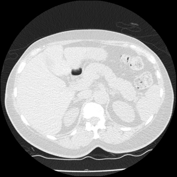 File:Acute interstitial pneumonitis (Radiopaedia 45404-49444 Axial lung window 102).jpg