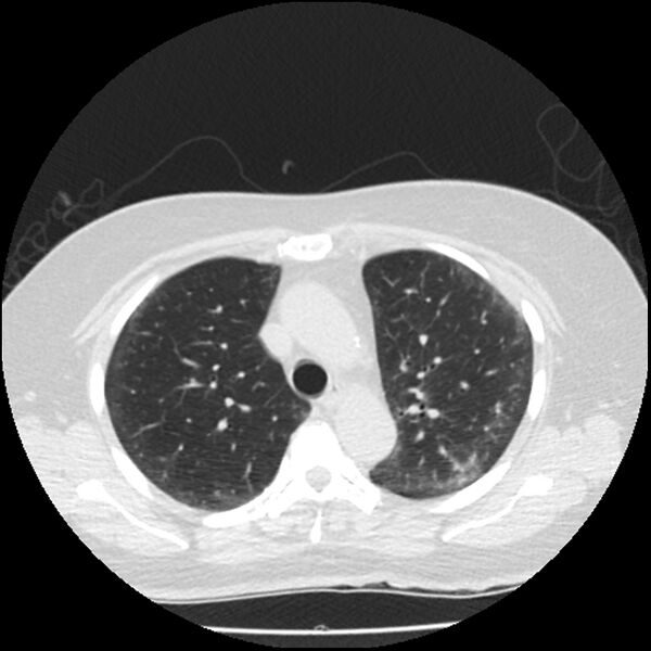 File:Acute interstitial pneumonitis (Radiopaedia 45404-49444 Axial lung window 34).jpg