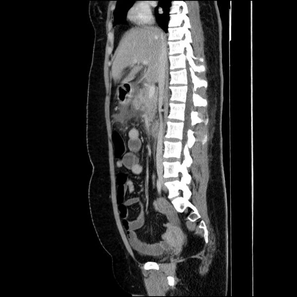 File:Acute pancreatitis (Radiopaedia 69236-79012 Sagittal C+ portal venous phase 57).jpg