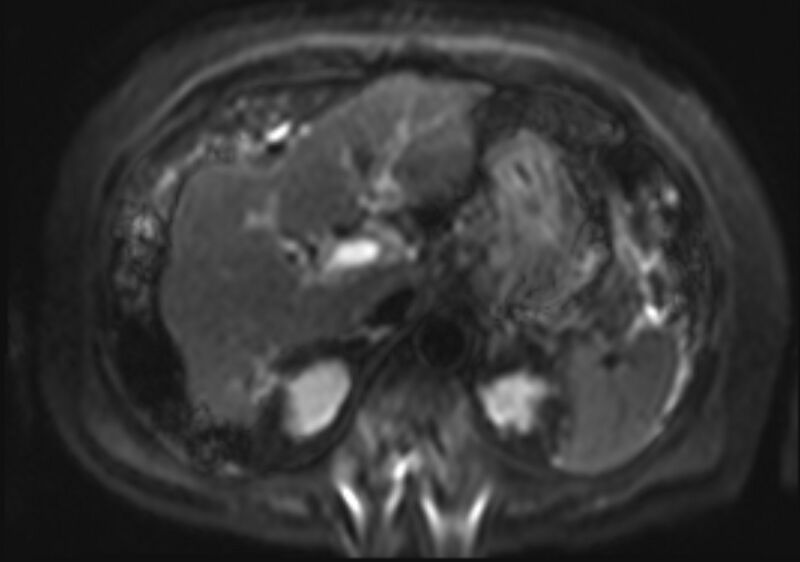 File:Acute portal vein thrombosis (Radiopaedia 73198-83925 Axial DWI 14).jpg