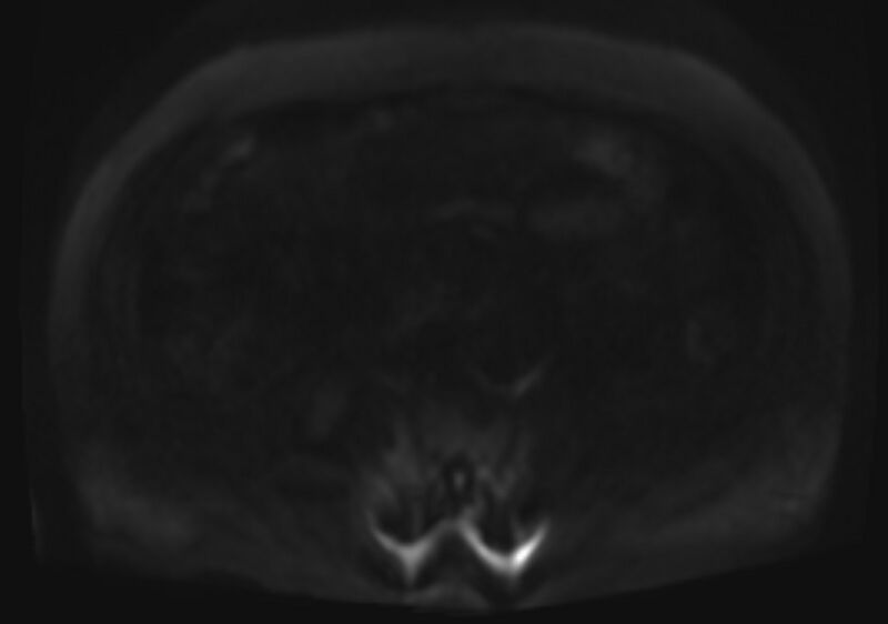 File:Acute portal vein thrombosis (Radiopaedia 73198-83925 Axial DWI 85).jpg