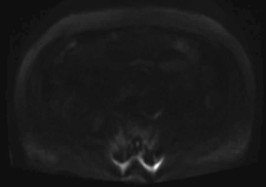 Acute portal vein thrombosis (Radiopaedia 73198-83925 Axial DWI 85).jpg