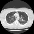 Acute pulmonary edema on CT (Radiopaedia 33582-34672 Axial lung window 13).jpg