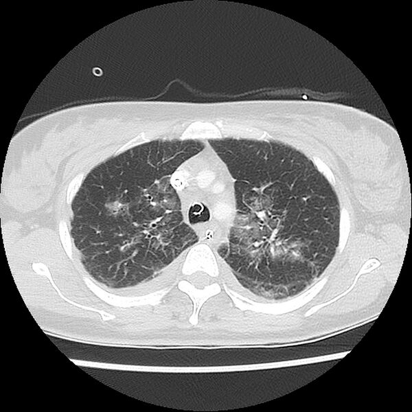 File:Acute pulmonary edema on CT (Radiopaedia 33582-34672 Axial lung window 13).jpg