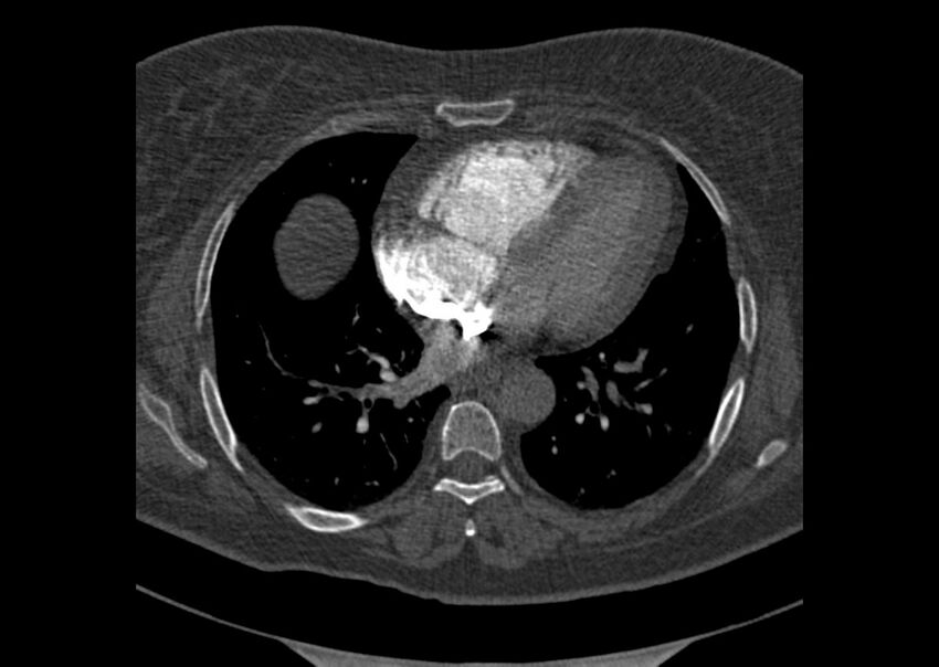 Acute pulmonary embolism (Radiopaedia 29938-30466 Axial C+ CTPA 133).jpg
