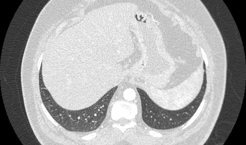 Acute pulmonary embolism with pulmonary infarcts (Radiopaedia 77688-89908 Axial lung window 119).jpg