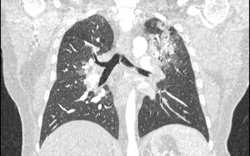File:Acute pulmonary embolism with pulmonary infarcts (Radiopaedia 77688-89908 Coronal lung window 58).jpg
