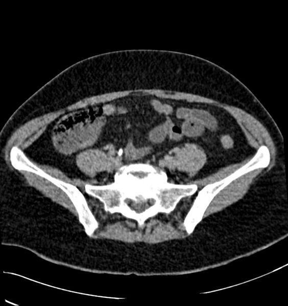 File:Acute pyelonephritis (Radiopaedia 40264-42816 Axial renal excretory phase 25).jpg