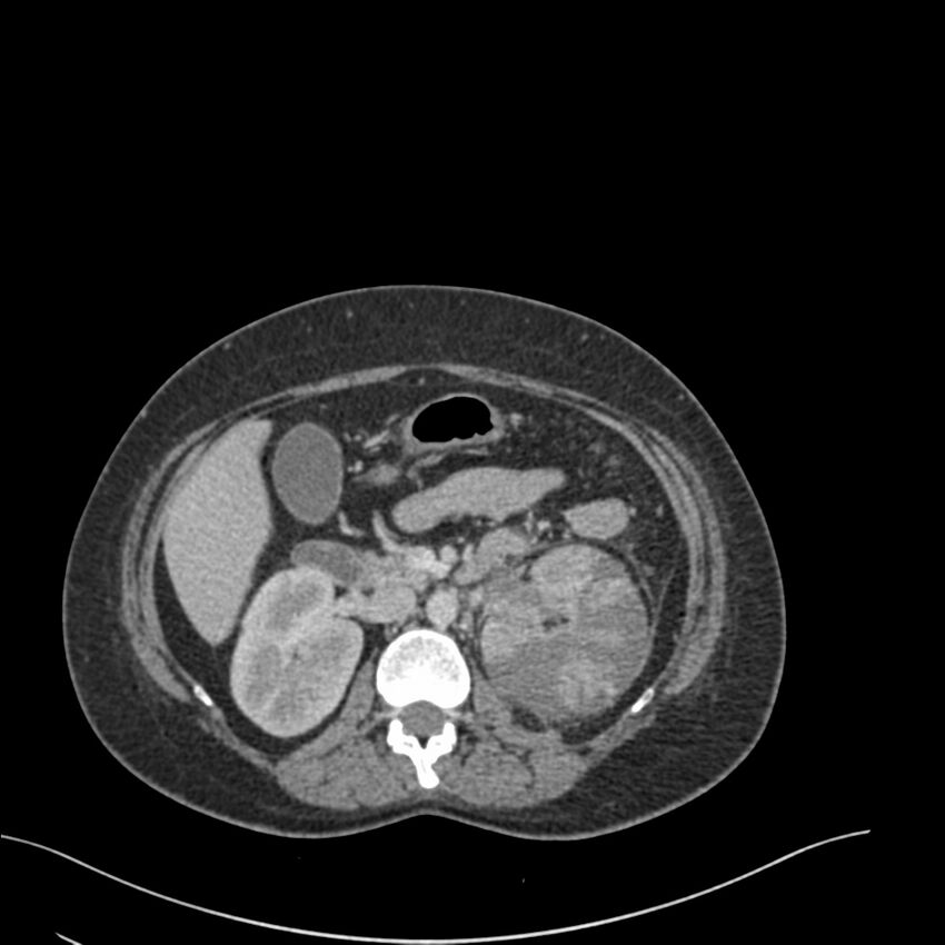 Acute pyelonephritis with renal vein thrombosis (Radiopaedia 58020-65053 Axial renal parenchymal phase 56).jpg