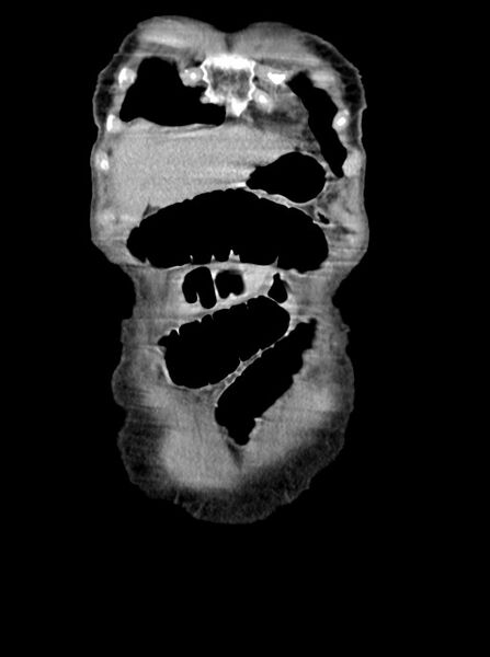 File:Acute small bowel (ileal) volvulus (Radiopaedia 71740-82139 Coronal C+ portal venous phase 15).jpg