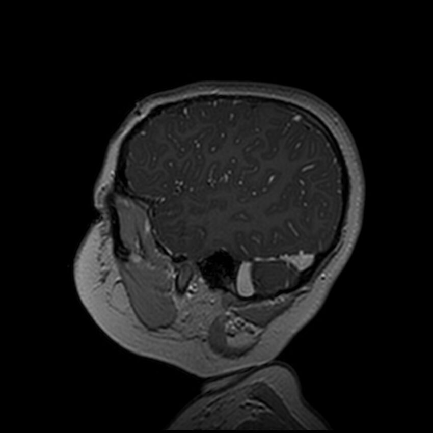 Adamantinomatous craniopharyngioma (Radiopaedia 77407-89529 H 23).jpg