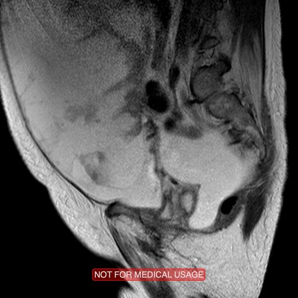 File:Adenocarcinoma of the cervix (Radiopaedia 28373-28615 Sagittal T2 3).jpg