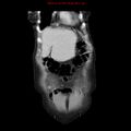 Adenocarcinoma of the colon (Radiopaedia 8191-9039 Coronal liver window 8).jpg