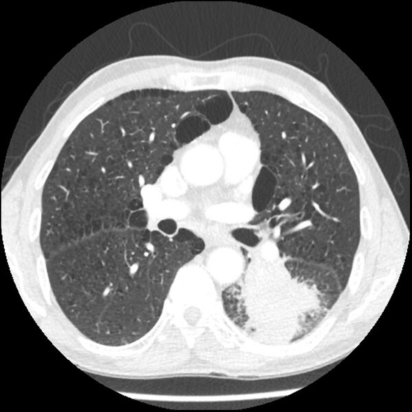 File:Adenocarcinoma of the lung - micropapillary predominant (Radiopaedia 42446-45563 C 41).jpg