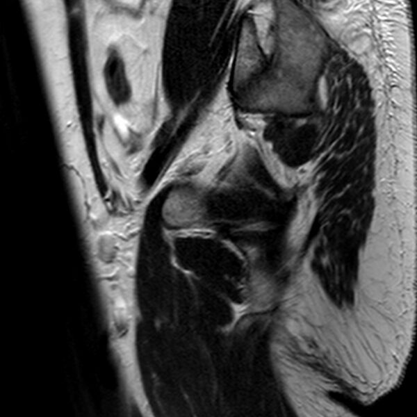 File:Adenomyoma of the uterus (Radiopaedia 9871-10439 Sagittal T2 3).jpg