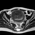 Adenomyoma of the uterus (huge) (Radiopaedia 9870-10438 Axial T2 25).jpg
