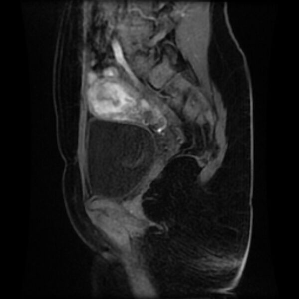 File:Adenomyosis within a septate uterus (Radiopaedia 69963-79981 Sagittal LAVA-Dyn 10).jpg
