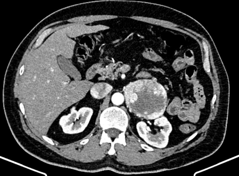 File:Adrenal metastases (Radiopaedia 73082-83791 Axial C+ arterial phase 58).jpg