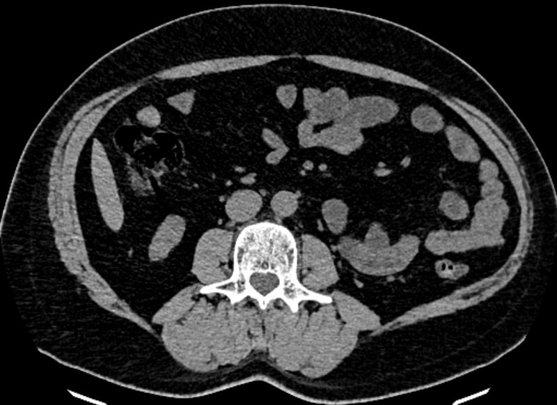 File:Adrenal metastases (Radiopaedia 73082-83791 Axial non-contrast 100).jpg