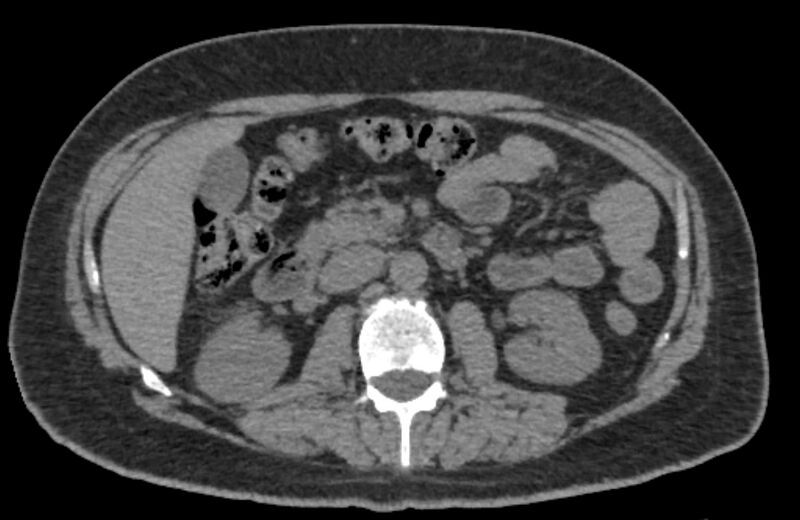 File:Adrenal myelolipoma (Radiopaedia 65240-74253 Axial non-contrast 61).jpg