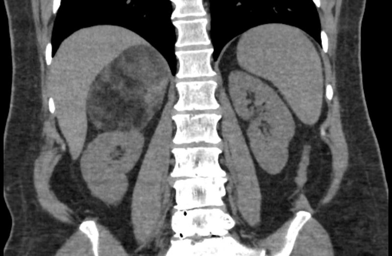 File:Adrenal myelolipoma (Radiopaedia 65240-74253 Coronal non-contrast 40).jpg