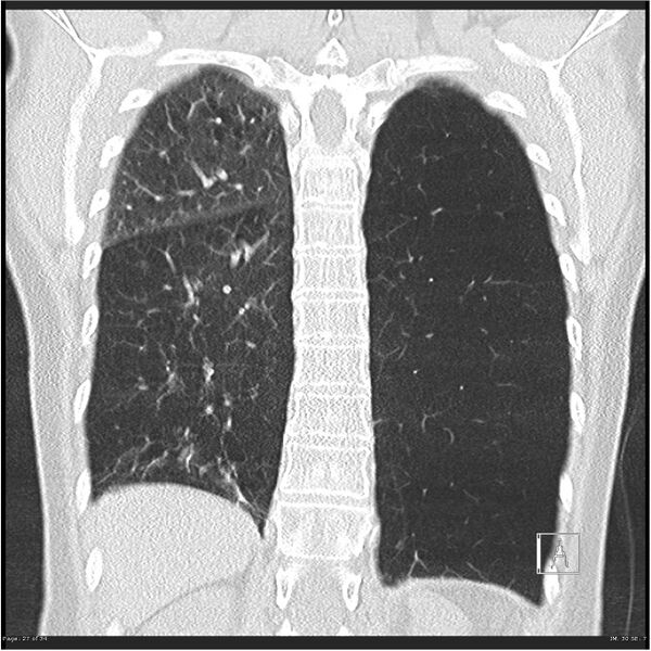 File:Alpha-1-antitrypsin deficiency (Radiopaedia 26537-26678 Coronal lung window 27).jpg
