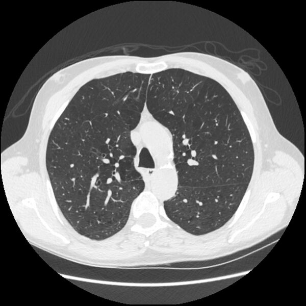 File:Alpha-1-antitrypsin deficiency (Radiopaedia 40993-43722 Axial lung window 76).jpg