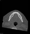 Ameloblastoma (Radiopaedia 18115-17901 Axial bone window 8).jpg