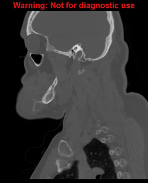 File:Ameloblastoma (Radiopaedia 33126-34164 Sagittal bone window 52).jpg