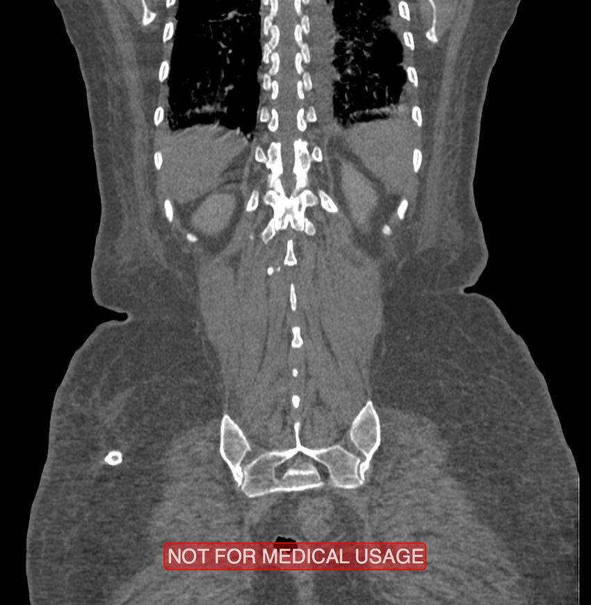 Amoebic enterocolitis with liver abscess (Radiopaedia 35100-36609 B 177).jpg