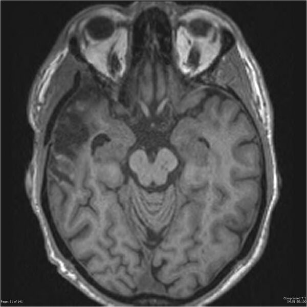 File:Anaplastic meningioma with recurrence (Radiopaedia 34452-35788 Axial T1 49).jpg