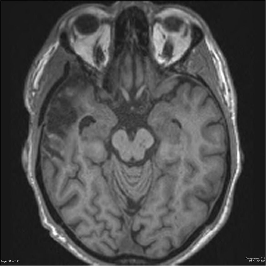 Anaplastic meningioma with recurrence (Radiopaedia 34452-35788 Axial T1 49).jpg