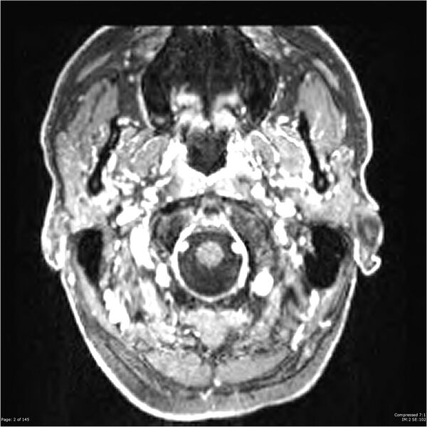 File:Anaplastic meningioma with recurrence (Radiopaedia 34452-35788 Axial T1 C+ 2).jpg