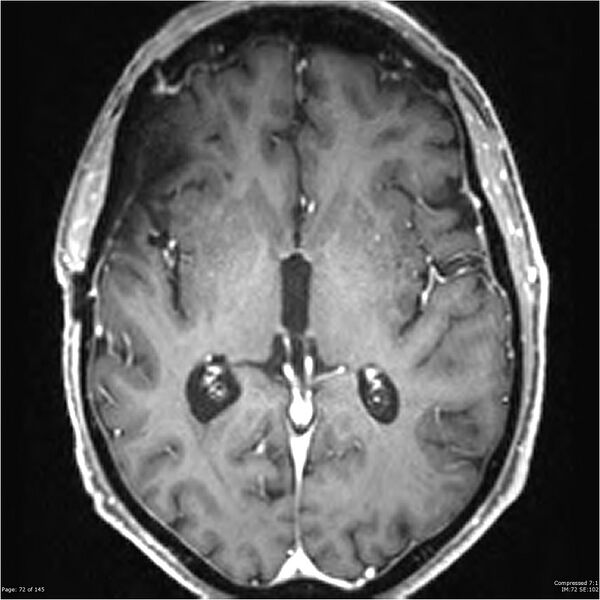 File:Anaplastic meningioma with recurrence (Radiopaedia 34452-35788 Axial T1 C+ 72).jpg