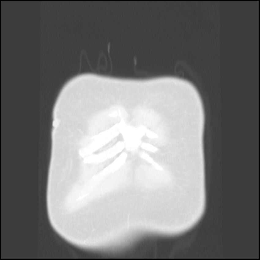Angioinvasive aspergillosis (Radiopaedia 43957-47466 Coronal lung window 91).jpg