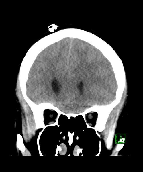 File:Angiomatous meningioma (Radiopaedia 79459-92578 Coronal non-contrast 12).jpg