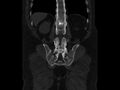 Ankylosing spondylitis (Radiopaedia 44609-48357 Coronal bone window 75).jpg