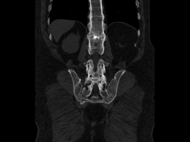 File:Ankylosing spondylitis (Radiopaedia 44609-48357 Coronal bone window 75).jpg