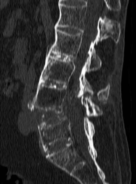 File:Ankylosing spondylitis complicated by fracture-dislocation (Radiopaedia 33583-34674 B 10).jpg