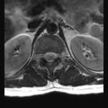 Ankylosing spondylitis with zygapophyseal arthritis (Radiopaedia 38433-40516 Axial T2 23).jpg