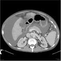 Annular pancreas and cirrhosis (Radiopaedia 24561-24843 A 4).jpg