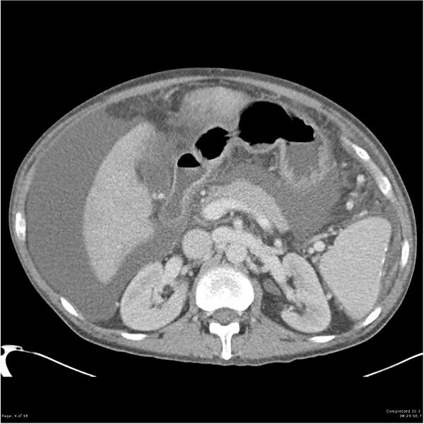 File:Annular pancreas and cirrhosis (Radiopaedia 24561-24843 A 4).jpg