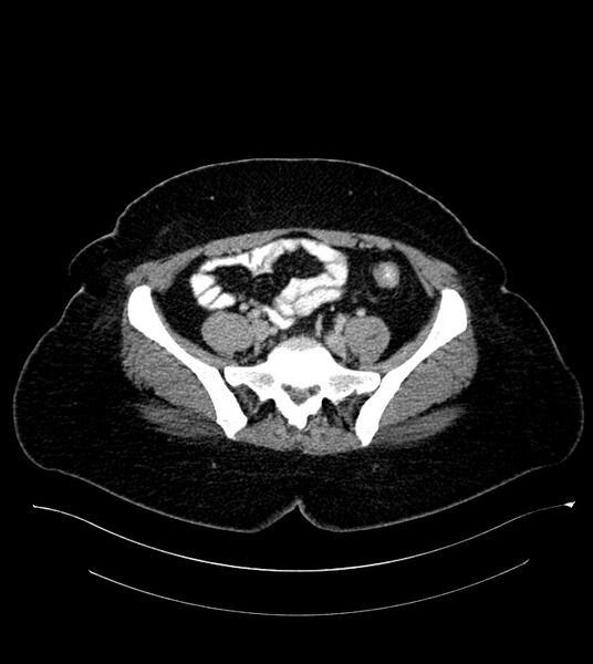 File:Anterior abdominal wall CSF pseudocyst (CSFoma) (Radiopaedia 79453-92571 A 67).jpg