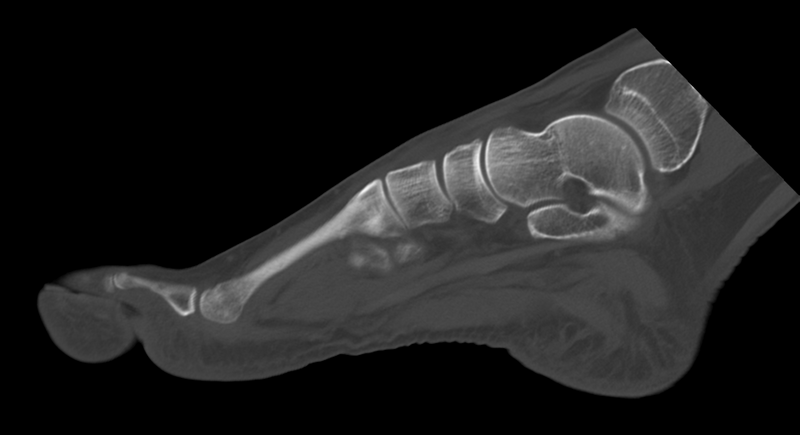 File:Anterior calcaneal process fracture (Radiopaedia 47384-51989 Sagittal bone window 19).png