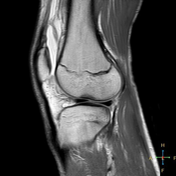 File:Anterior cruciate ligament tear - complete (Radiopaedia 24907-25170 Sagittal PD 4).jpg