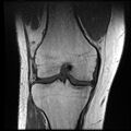 Anterior cruciate ligament tear with posteromedial corner injury, bucket-handle meniscal tear and chondral delamination (Radiopaedia 75501-86744 Coronal T1 14).jpg