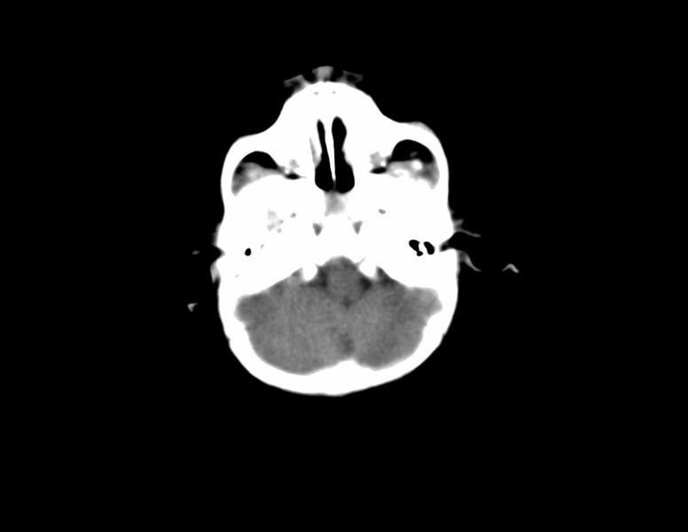 File:Anterior plagiocephaly (Radiopaedia 71836-82273 Axial non-contrast 2).jpg