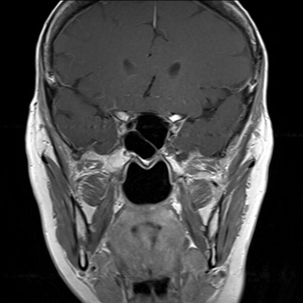 File:Anterior temporal encephalocele (Radiopaedia 82624-96808 Coronal T1 3).jpg